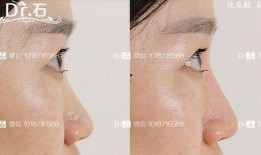 微整形隆鼻最新爆料视频